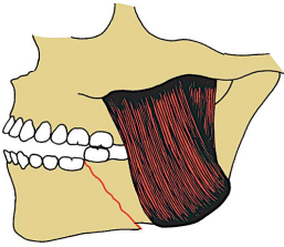 <p><span style="color: red;">open reduction </span>may be needed</p><p>fracture line and muscle pull <span style="color: red;">displaces the fracture</span></p><p>make a flap through either skin or mucosa to see the bone</p><p>separate the fragments and increase the gap of the fracture</p>
