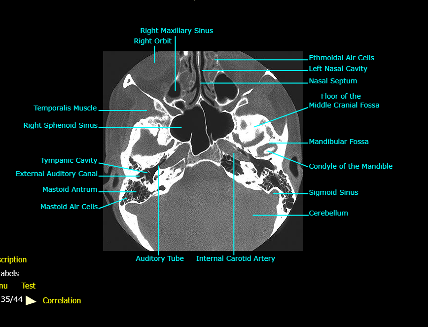 <ol><li><p>Ethmoidal Air Cells</p></li><li><p>Nasal Cavity</p></li><li><p>Nasal Septum</p></li></ol><p></p>