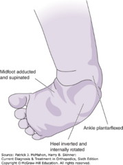 <p>Contracture of the medial tendons of the foot with subsequent deformity of Achilles, ankle, hindfoot, and midfoot</p><p>Characterized by fixed ankle plantar flexion, inversion of subtalar joint, medial subluxation of talonavicular joint</p>