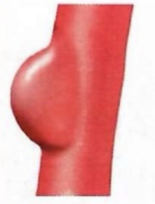 <p>A “neck” or connecting stalk in an aneurysm off the aorta. bulging in one area of the vessel</p>