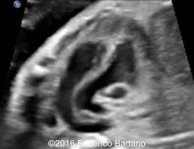 <ul><li><p>aorta arises from the right ventricle </p></li><li><p>pulmonary artery arises from left ventricle</p></li></ul><p></p><p>normal 4ch view, no crossing of tracts</p><p></p>