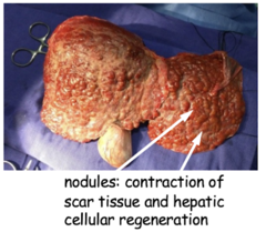 <p>list 4 causes of irreversible cirrhosis</p>