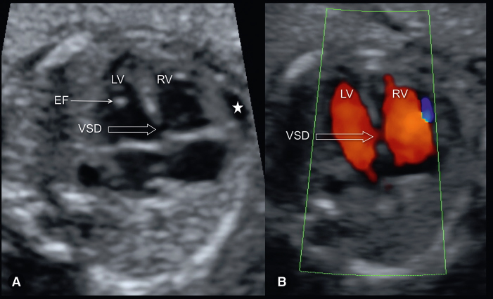 <p>Echogenic structure most commonly located within the left ventricle</p>