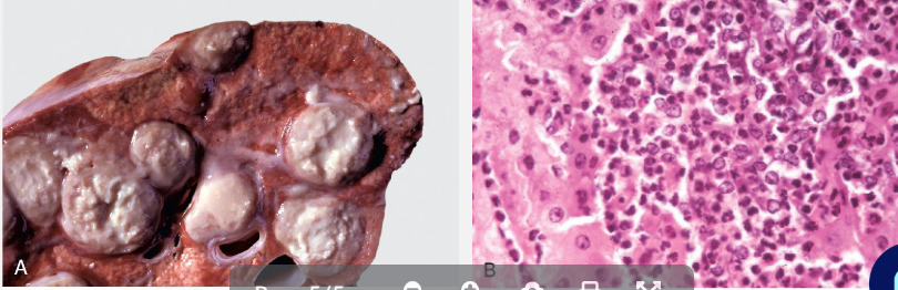 <p>A, Abscess, lung, cow. A cut section of lung has numerous abscesses. Note</p><p>the white-to-grey exudate and how it bulges from the cut surface</p><p></p><p>B, The exudate in A consists of cell debris and a large number of neutrophils</p><p>admixed with lesser numbers of degenerating macrophages and</p><p>lymphocytes, and bacteria (the latter not visible with H&amp;E stain).</p>