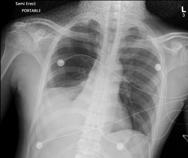 <p>RML and RLL atelectasis, witch obscuration of both right cardiac border and right hemidraphragm, with a linear superior margin directed towards the hilum. </p>