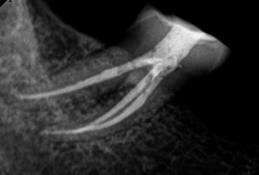 <p>What % of mandibular molars have their <strong>mesial</strong> root with 2 canals and 1 foramina (canals join)?</p>