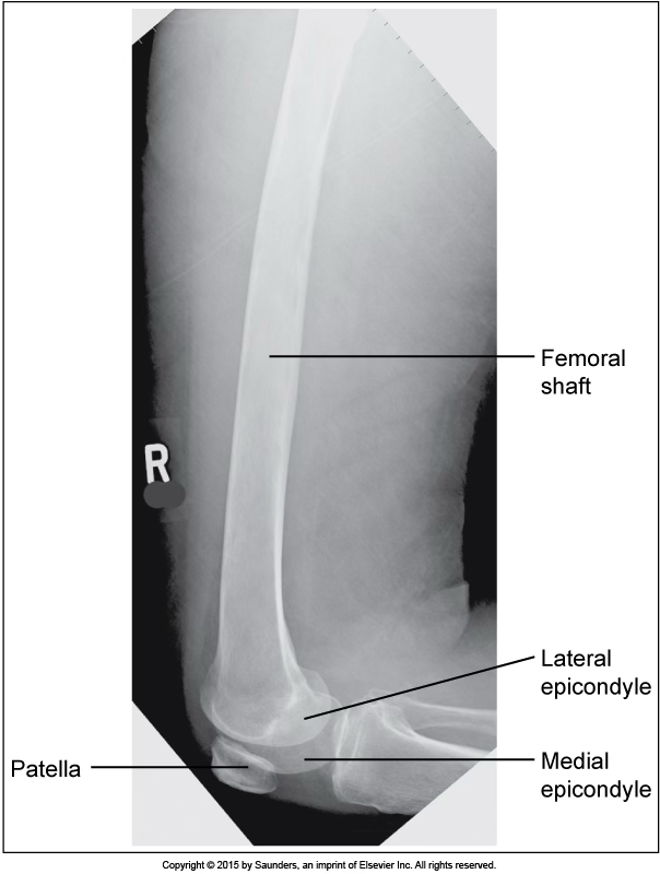 <p>lateral femur</p>