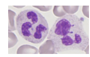 <p>- Neutrophil count <1.5 x 10^9/L</p><p>.</p><p>Causes:</p><p>- Congenital (rare); Benign ethnic neutropenia</p><p>- Drug-induced: Antibiotics; cytotoxics</p><p>- Infections: Viral or bacterial</p><p>- Bone marrow failure (pancytopenia)</p><p>.</p><p>- Risk of severe &amp; recurrent bacterial infection</p><p>- Assoc. with infections of mouth and throat</p><p>.</p><p>Therapy:</p><p>- Treat underlying cause</p><p>- Antibiotics: prophylactic for procedures</p>