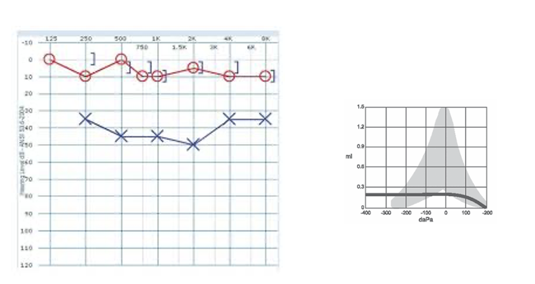 <p>ECV: normal </p><p><span>Otoscopy: Clear of cerumen, whitish mass behind TM</span></p>