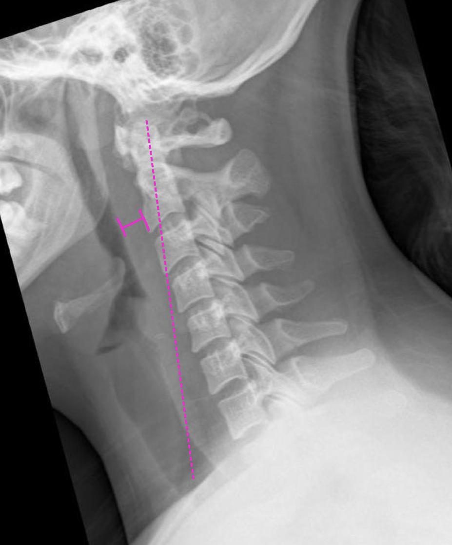 <p>What type of weight bearing is this pt</p>