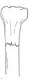<p>Transverse Fracture</p>