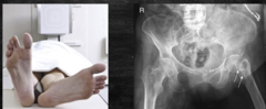 <p>How would the feet lie to determine a hip fracture?</p>