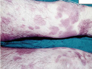 <p>Case</p><p>During examination of a dead body, multiple-coloured patches are observed on the skin, as shown in the image.</p><div data-type="horizontalRule"><hr></div><p>Questions</p><ol><li><p>What is the name of this postmortem change?</p></li><li><p>Describe the initial stage of this postmortem change.</p></li><li><p>What is the main differential diagnosis (D.D.) for this condition?</p></li></ol><p></p><p></p>