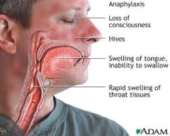 <p>Manifested by hypotension (early sign), generalized urticaria, angioedema, and laryngeal edema</p><p>Vasodilation due to loss of vasomotor tone and capillary leak resulting from the release of mediators from tissue cells in an immediate hypersensitivity reaction</p>