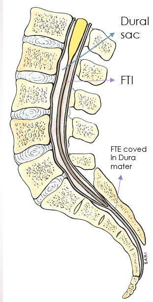 <p>FTI passes through (and gains a layer of dura) and continues as filum terminale externum (FTE)</p><ul><li><p>FTE continues inferiorly and attaches to coccyx as the coccygeal ligament</p></li></ul><p></p>
