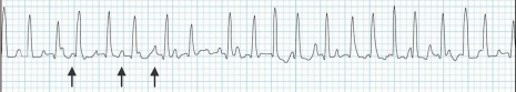 <p>What condition is associated with this EKG finding?</p><p>-Give verapamil</p>