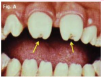 <p>tapered and <span style="color: red;">notched incisal edges</span> with <span style="color: red;">screwdriver shapes</span></p><p>caused by congenital syphilis → treponema pallidum</p><p><strong>tx:</strong> penicillin</p>
