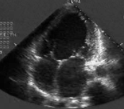 <ul><li><p>absence of IVS</p><ul><li><p>best view → <span style="color: rgb(255, 0, 255);">A4C</span></p></li></ul></li></ul><p></p>