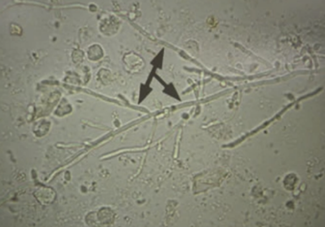 <p>⚠️‼️(#10)75.These structures were seen in a KOH wet mount taken from a vaginal discharge caused by: A.Gardnerella sp B.Trichomonas C.Neissera sp. D.Candida albicans</p>