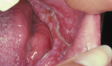 <p>chemical burn </p>