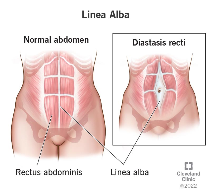 <p>A narrow tendinous sheath running down the midline of the abdomen from the sternum to the pubic symphysis, formed by the fusion of abdominal aponeuroses.</p>