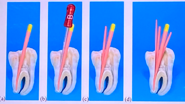 <p>most <span style="color: red;">commonly taught</span> technique</p><p>uses a <span style="color: red;">master gutta-percha cone</span> and additional <span style="color: red;">accessory cones </span>compacted laterally using a <span style="color: red;">spreader and sealer</span></p>