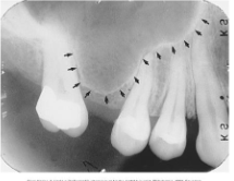 <p>Maxillary Sinus</p>