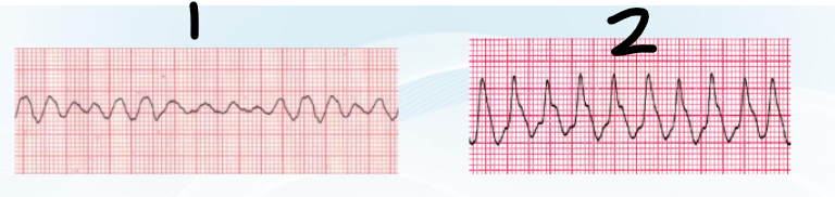 <p>SHOCKABLE rhythms =</p>