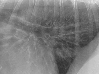 <p>Bronchial pattern</p><ul><li><p>well defined nodular pattern</p></li></ul><p></p>