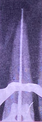 <p><span>Violates the periodontal ligament and alveolar bone</span></p><p><span>﻿﻿Loss of apical constriction creates: ﻿﻿</span></p><ul><li><p><span>An open apex ﻿﻿</span></p></li><li><p><span>Lack of an adequate apical seal</span></p></li><li><p><span>﻿﻿Pain &amp; discomfort to the patient</span></p></li></ul><p></p>