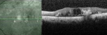 <p>classify the mac edema:</p>