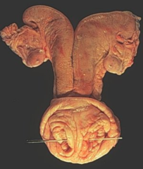 <p>This occurs when two cervixes connect to respective uterine horn</p>
