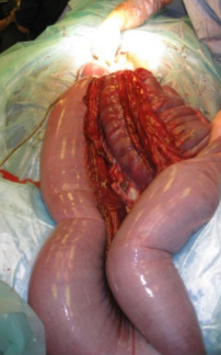 <p>Which parts of the colon can we visualise?</p>