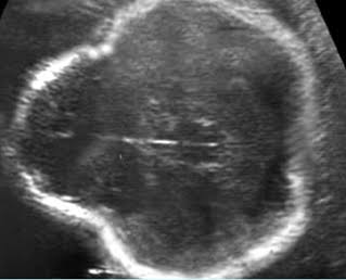<p>m/c lethal skeletal dysplasia </p><ul><li><p>severe rhizomelia, micromelia</p></li><li><p>cloverleaf skull</p></li><li><p>frontal bossing </p></li></ul><p></p>