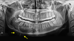 <p>describe the effect of the lesion:</p>
