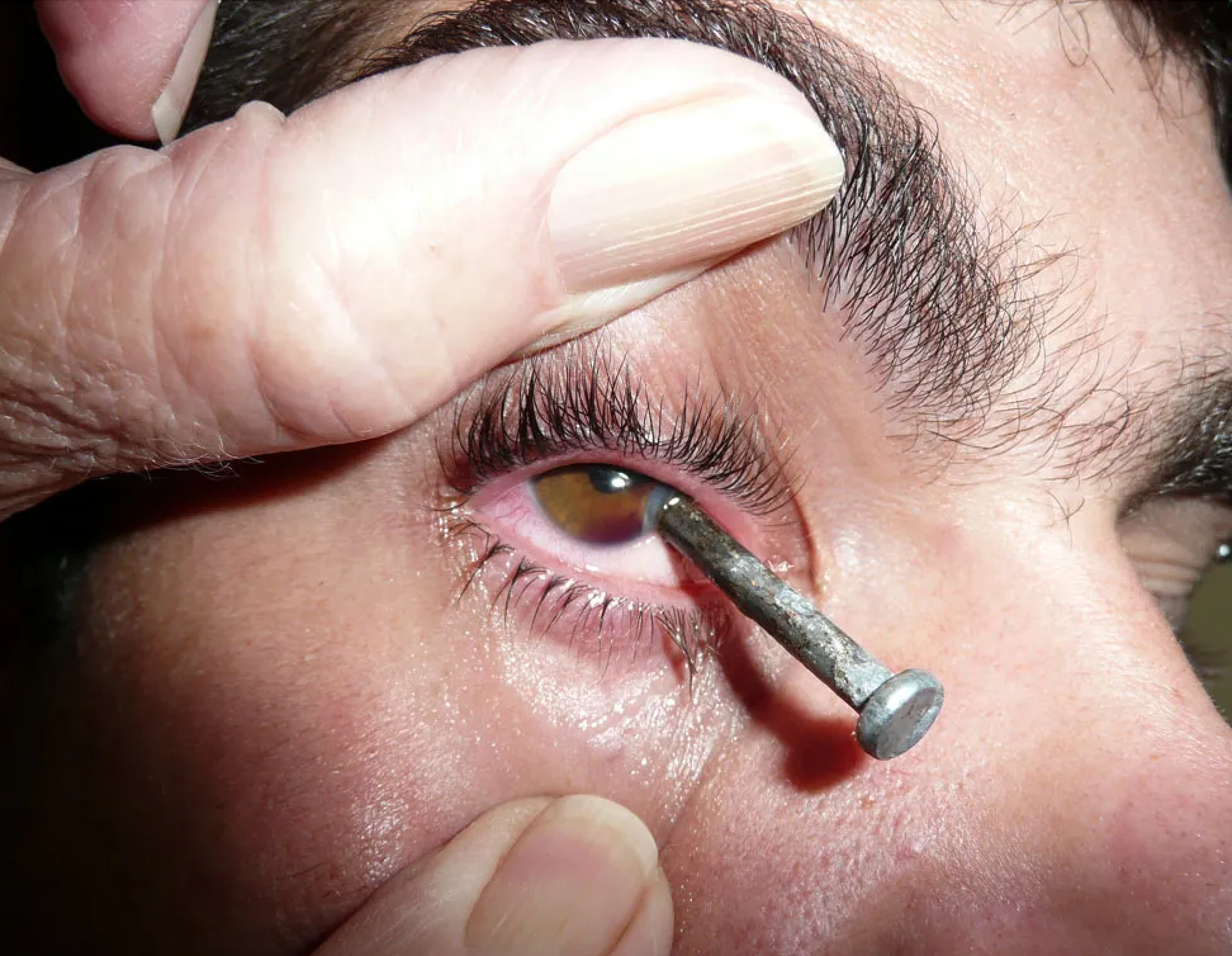 <p>What bandaging technique should be used for this injury?</p>