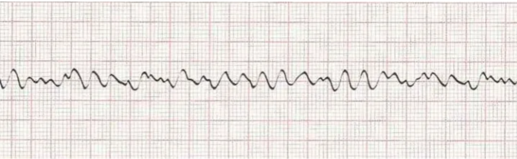 <p>s/s: actively going into cardiac arrest </p><p>nursing interventions: cardioversion</p>