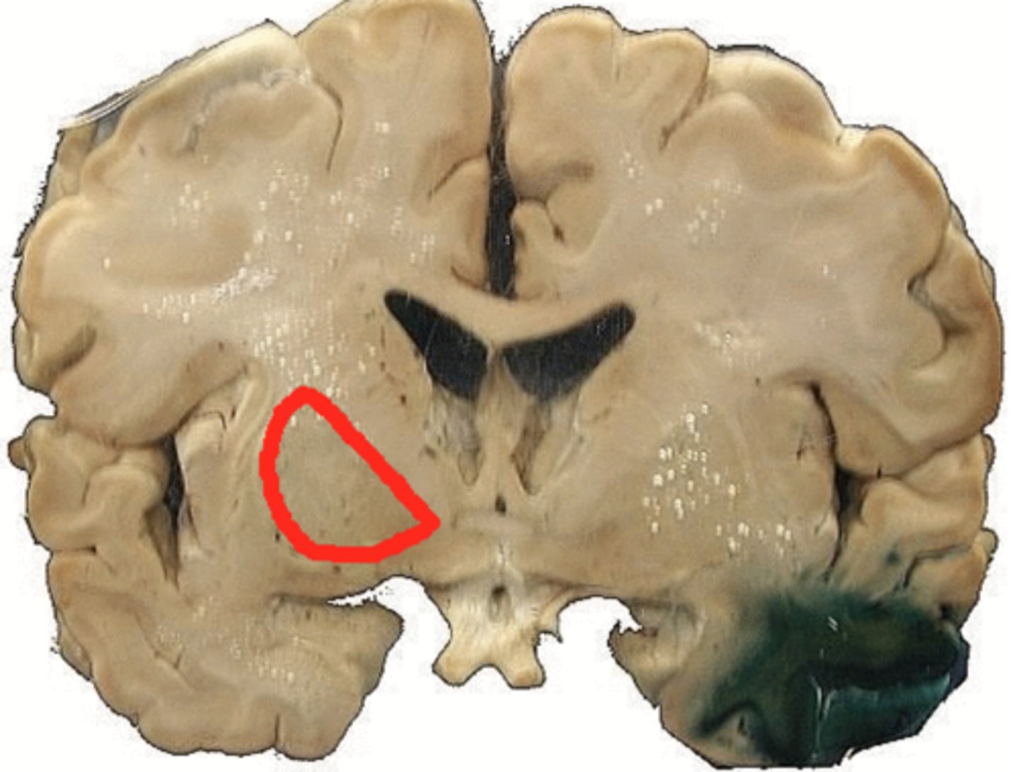 <p>Areas of cerebral gray matter composed of paired nuclei (clusters of neuron cell bodies in the CNS) that are found deep within each cerebral hemisphere.</p>