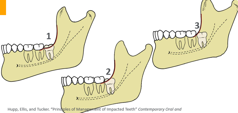 <p>-relates impaction to location of mandibular ramus</p>