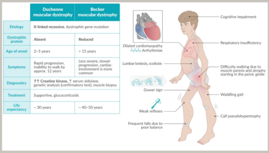 <p>X-linked recessive disease affecting MSK system (most severe form of muscular dystrophy) causing progressive muscle paresis and atrophy</p><p>Disease onset usually at age 2-3yrs; Life exp. 30yrs</p><p>Rapidly progressing (ambulatory inability by age 12)</p><p><strong>RF</strong>: Males only, age 2-5yrs, genetic/FHx</p><p><strong>Sx</strong>: progressive muscle paresis/atrophy (starts proximal LLs/pelvic girdle, extends upwards), ↓ reflexes, ↓ cogn, waddling gait (Duchenne limp) w bilat. Trendelenberg sign, Gower Maneuver (‘walking up’ body), Calf pseudohypertrophy, scoliosis, dilated cardiomyopathy</p><p><strong>Ix</strong>: Creatine Kinase (↑↑), Serum Aldolase (↑), Genetic analysis (dystrophin gene mutation), Muscle Biopsy (absent dystrophin protein)</p><p><strong>Mx</strong>: Supportive (physiotherapy, psychology, Ventilation, assistive devices/wheelchair), Glucocorticosteroids (<em>Prednisalone</em>), <em>Eteplirsen</em> (Antisense Oligonucleotide)</p><p><strong>Cx</strong>: cardiac/resp failure </p>