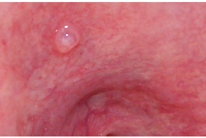 <p>superficial mucoceles</p>