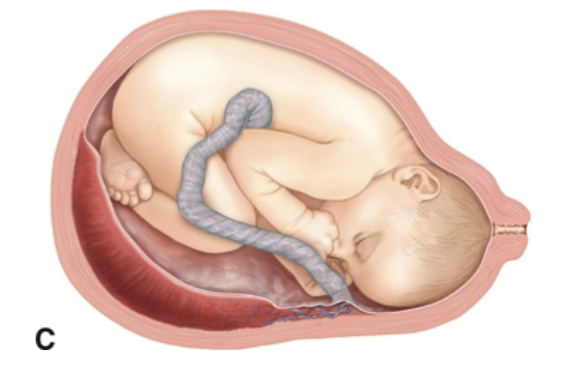 <p>most often have velamentous umbilical cord insertion </p>