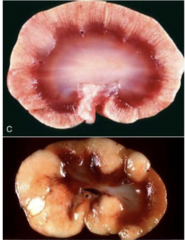 <p>Which renal neoplasia is being shown?</p>
