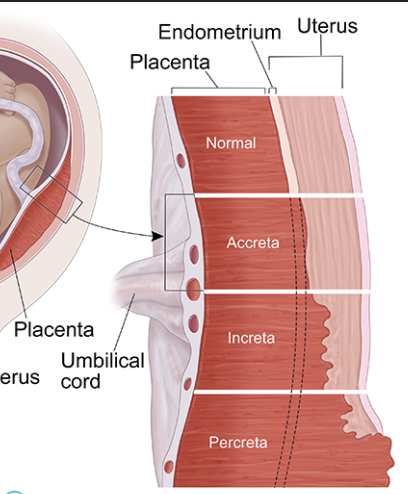 <p>percreta</p>