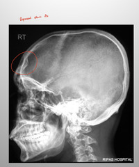 <p>Depressed skull Fx</p>