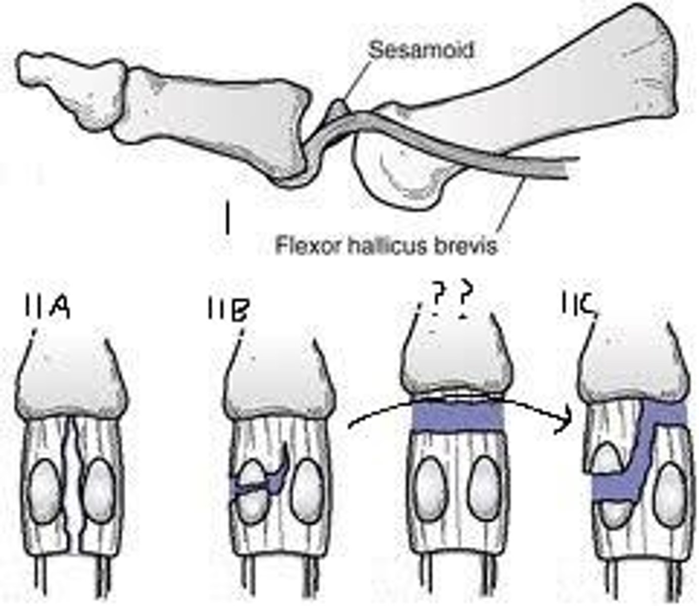 <p>1st Metatarsal Dislocations:</p><p>Type l - dorsal dislocation of proximal phalanx and sesamoids with intact intersesamoid ligament</p><p>Type 2 - dorsal dislocation of proximal phalanx and sesamoids</p><p>2A - intact sesamoids with ruptured of intersesamoid ligament</p><p>2B - transverse fracture of sesamoid with intact intersesamoid ligament</p>