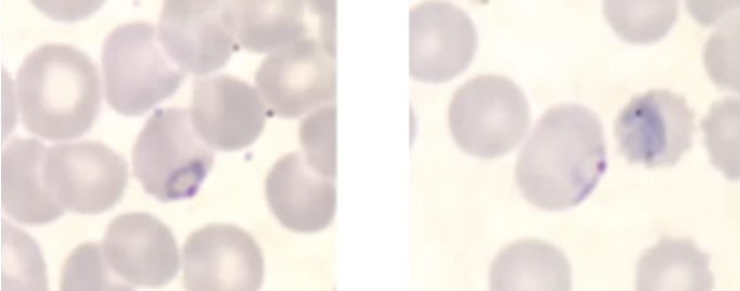 <ul><li><p><span style="background-color: transparent;">The Plasmodium falciparum developing trophozoite is characterized by the presence of heavy ring forms.</span></p></li><li><p><span style="background-color: transparent;">Fine pigment and granules may also be visible.</span></p></li><li><p><span style="background-color: transparent;">Mature stages of this form are not routinely seen in the peripheral blood.</span></p></li></ul><p></p>
