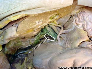<p>what structure is being indicated to in the image; for context , this structure lies posterior to the free edge of the lesser omentum</p>