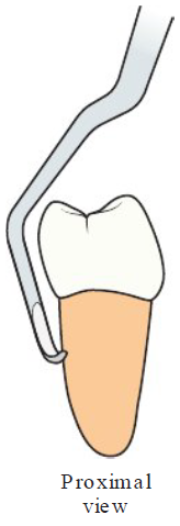 <p><strong>Complex shank on lingual and proximal surface</strong></p>