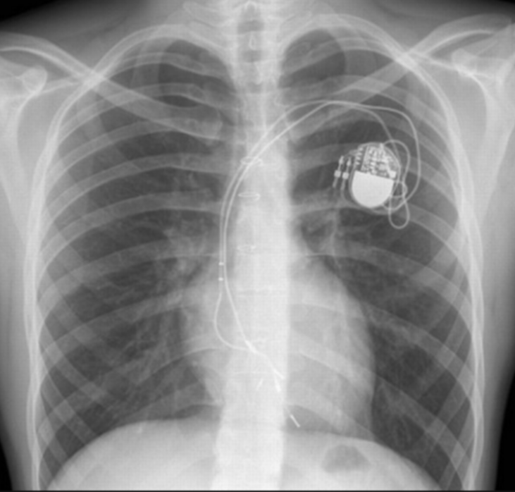 <ul><li><p>Maintain cardiac rhythm</p></li><li><p>Tip of pacemaker electrode should be positioned at the apex of right ventricle</p></li></ul><p></p>